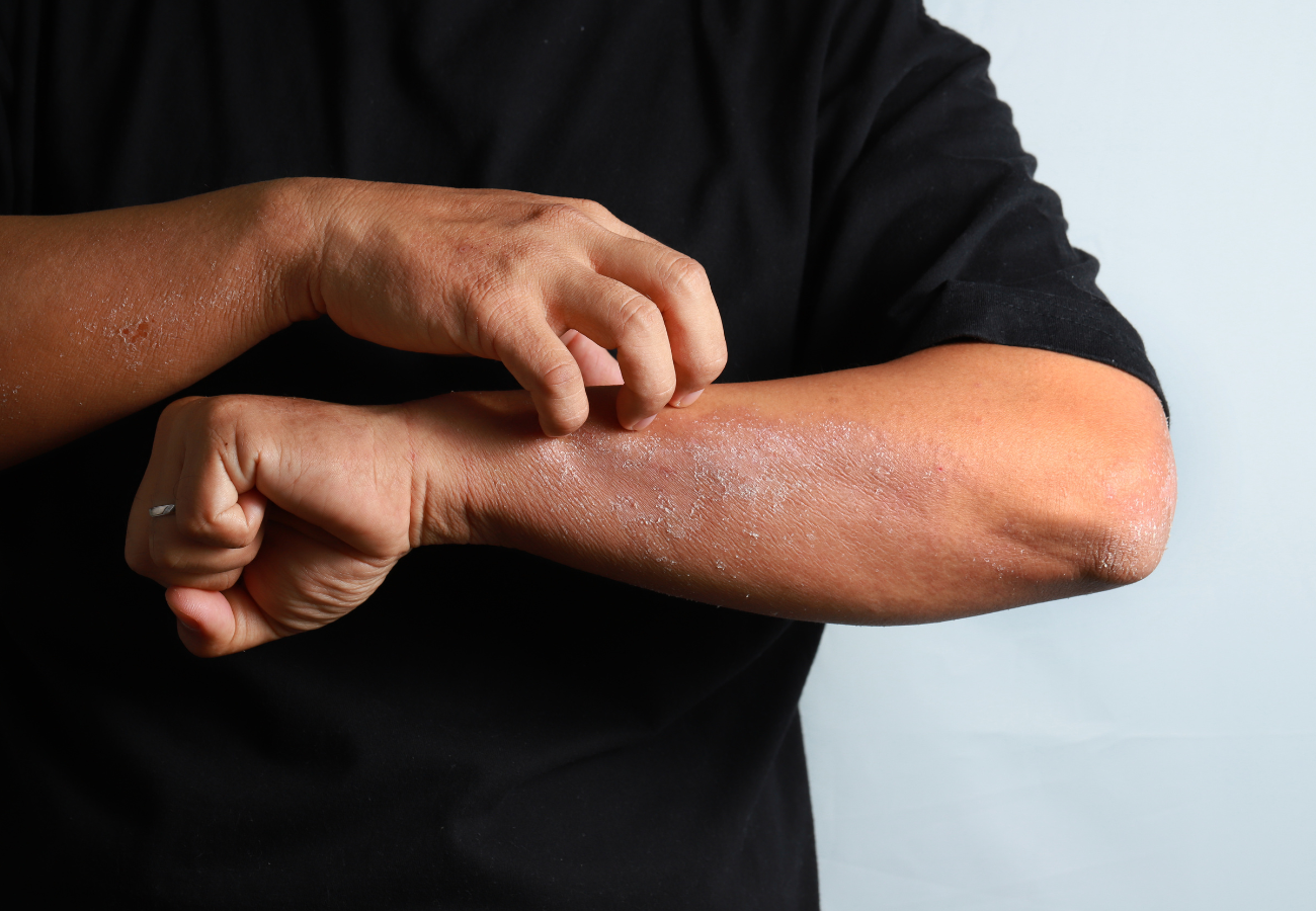 Man scratching his arm due to an eczema flare up